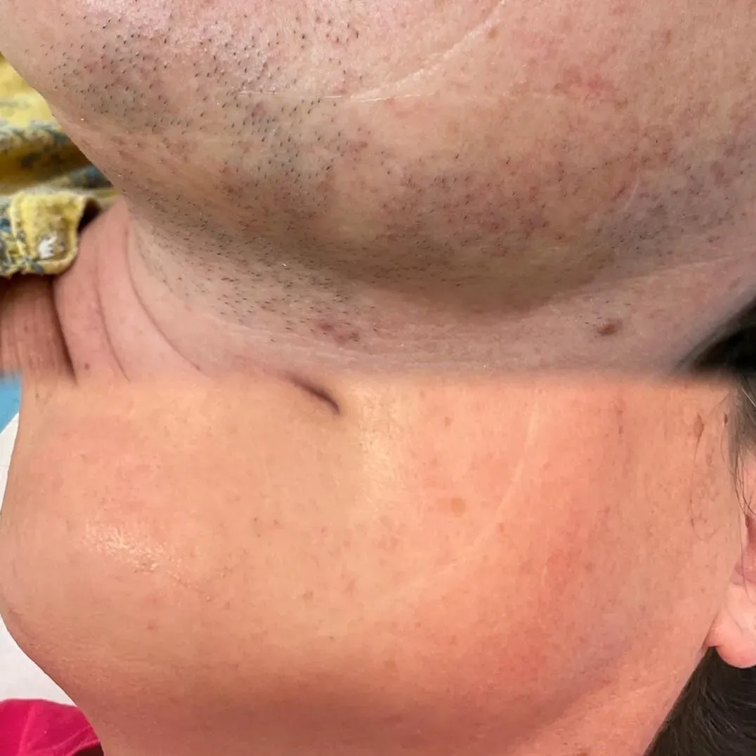 Laser Hair Removal result