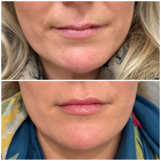 Lip Filler result