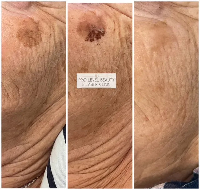 IPL - Pigmentation result