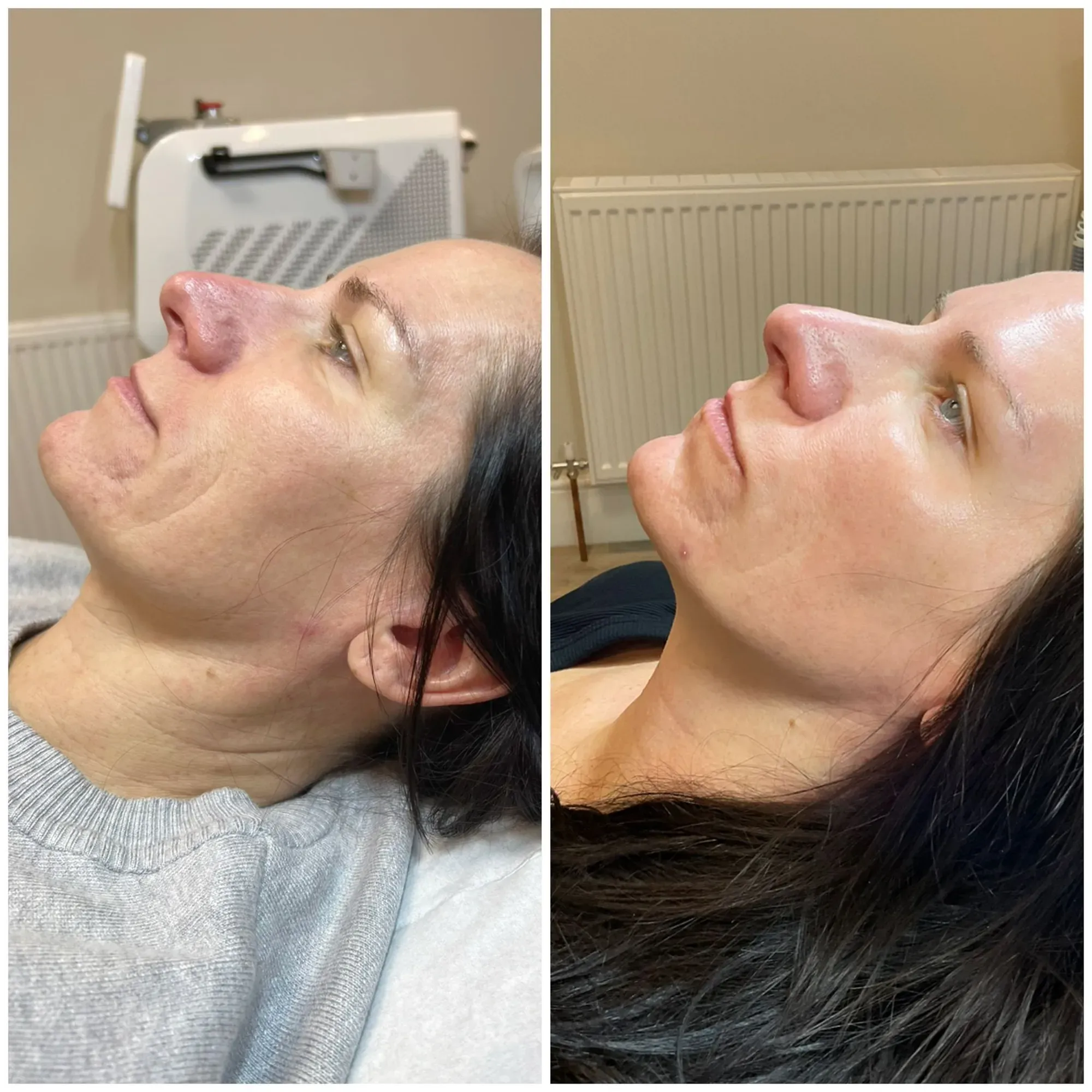 RF Microneedling result