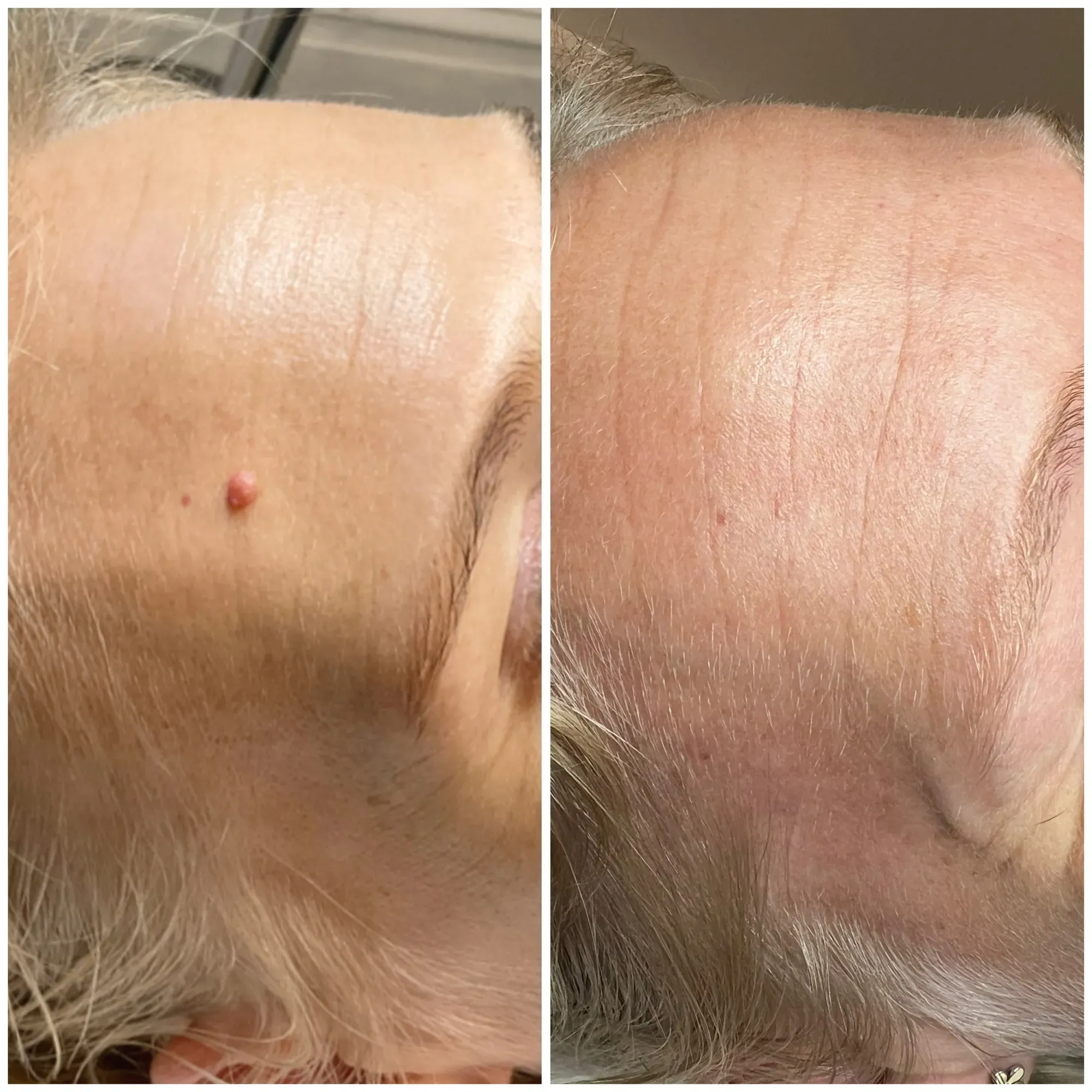 Skin Tag Removal result
