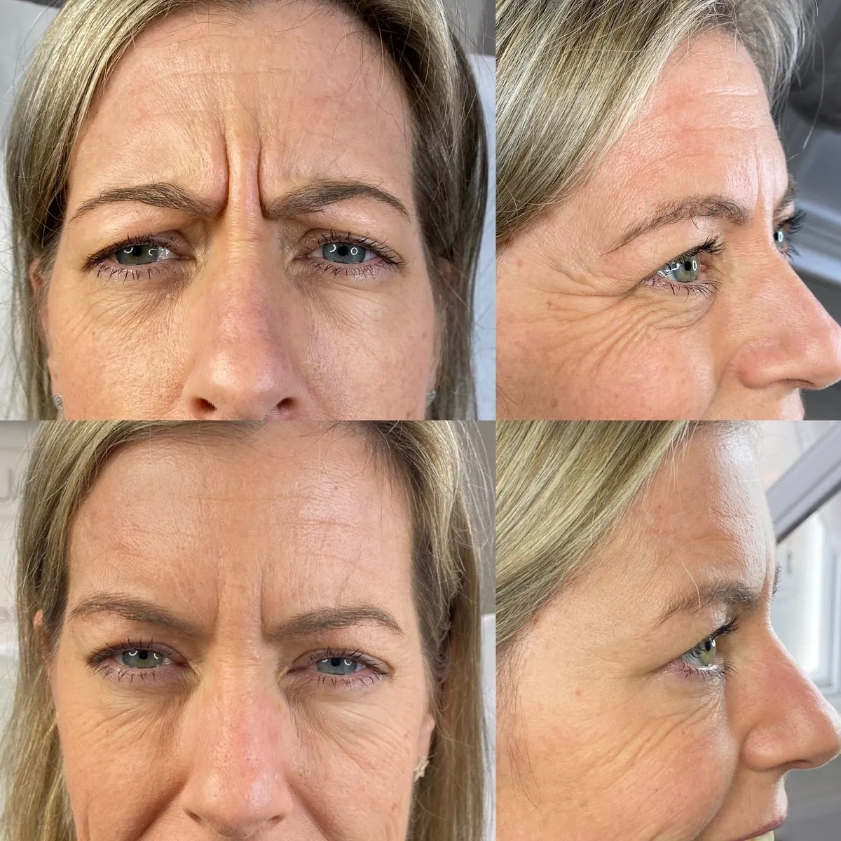 Anti-Wrinkle Treatment