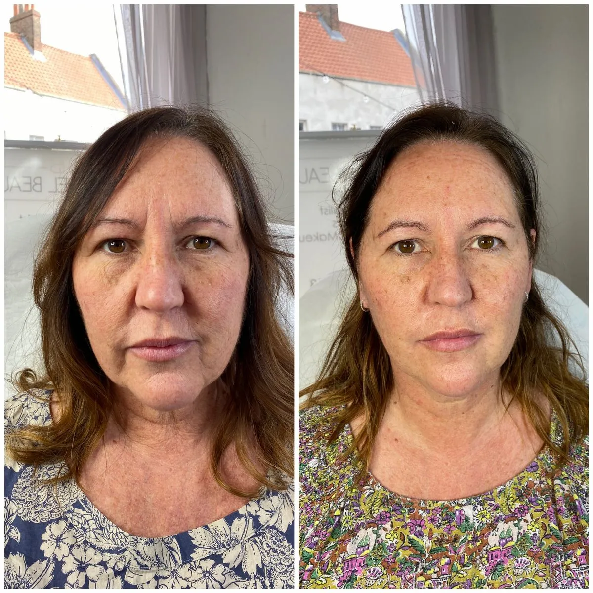 Dermal Fillers