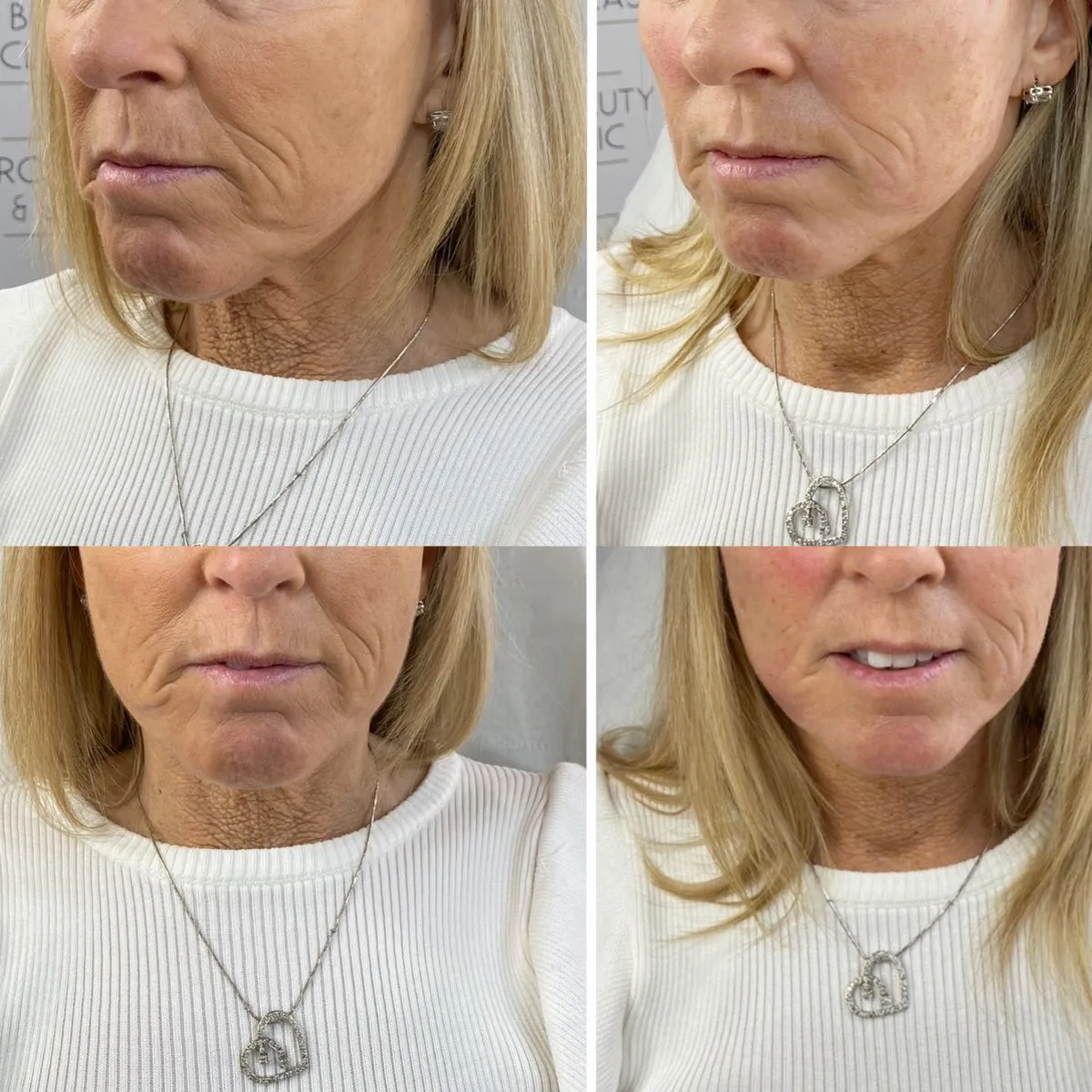 Before and after · results vary