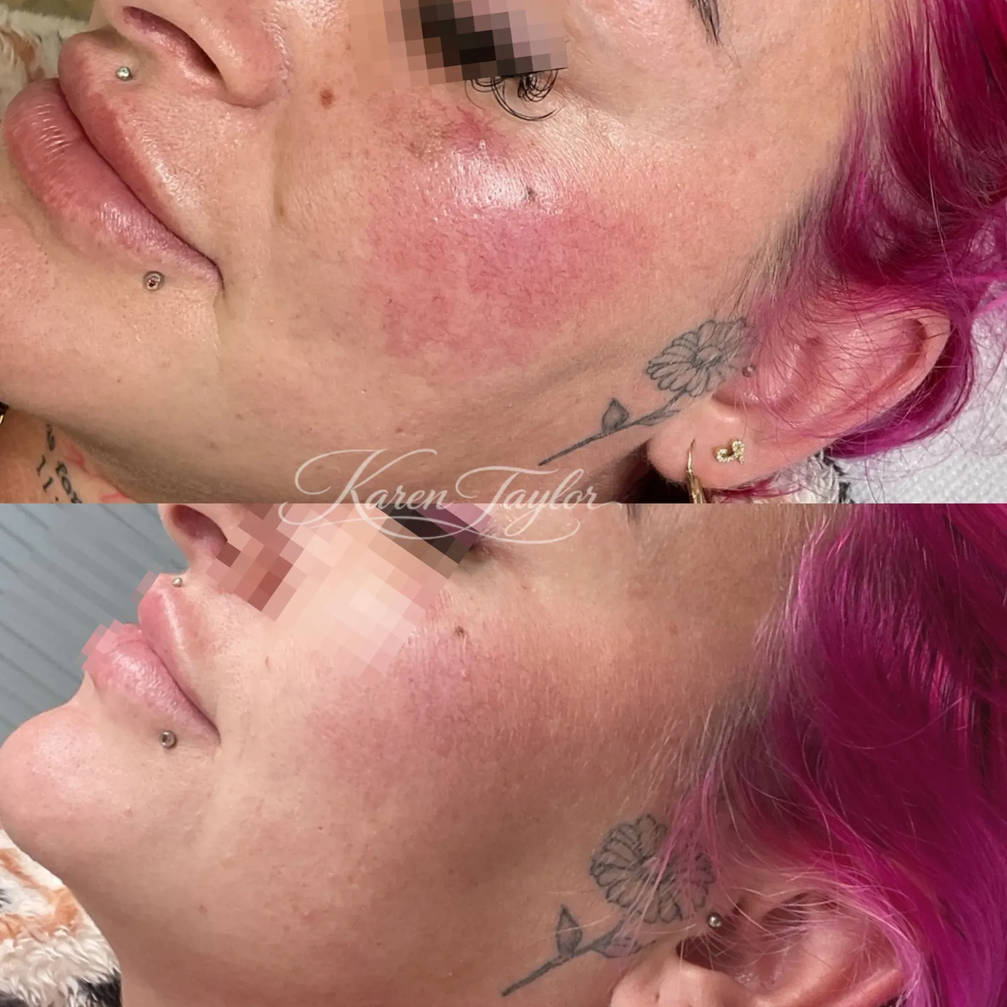 IPL - Thread Veins - Rosacea result