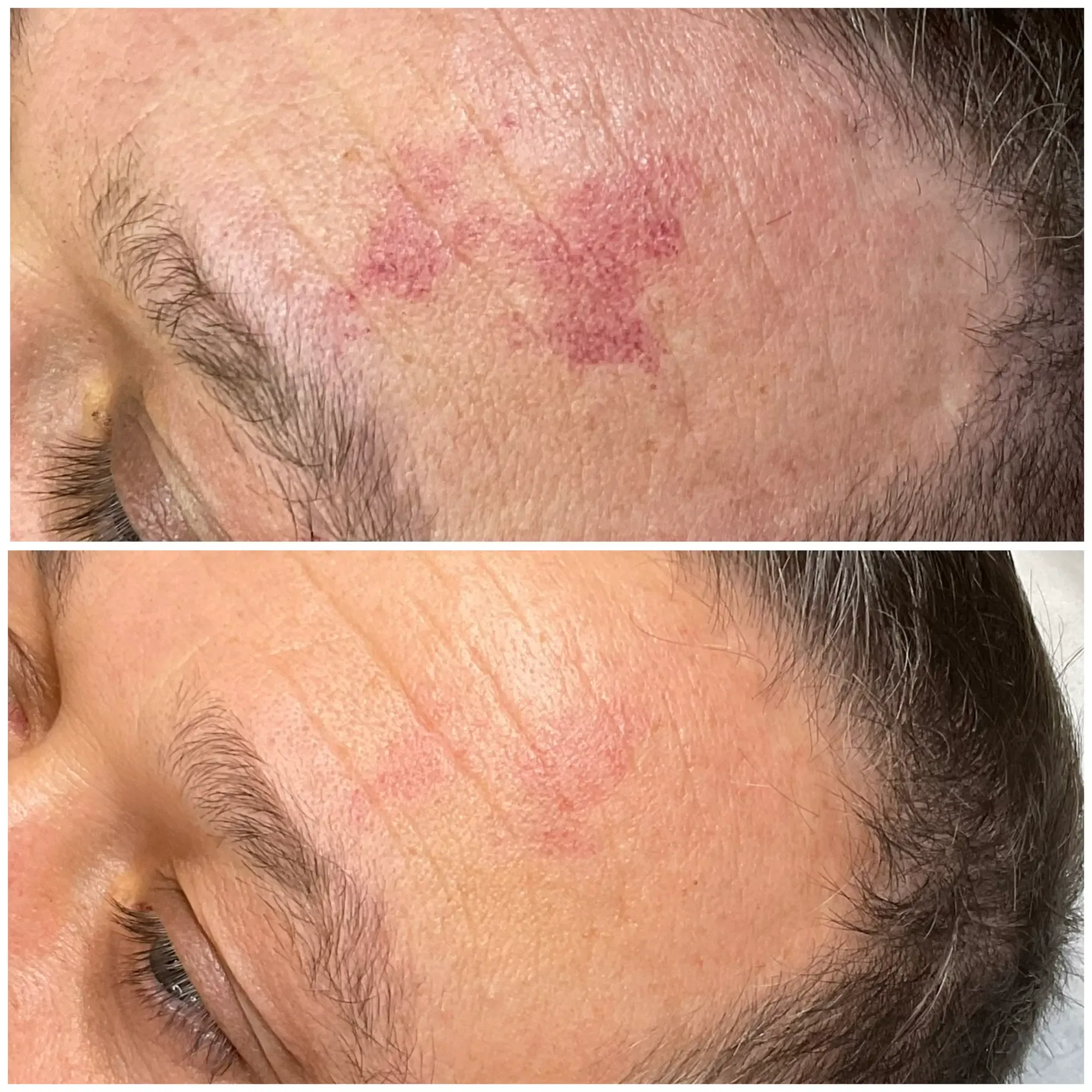 IPL - Thread Veins result