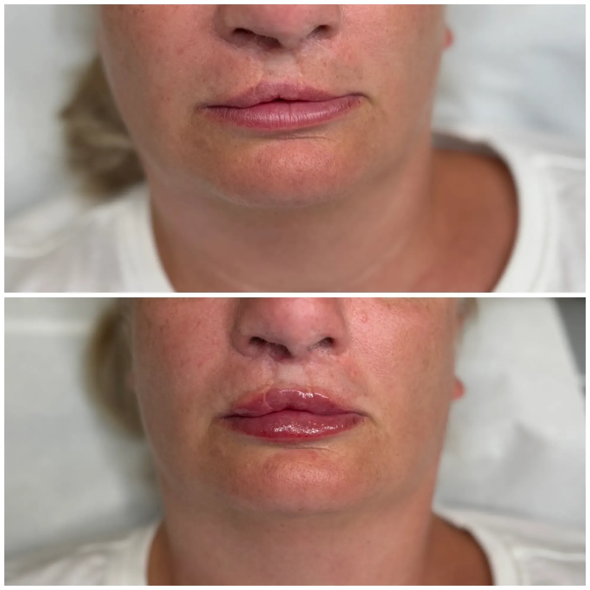Lip Filler result