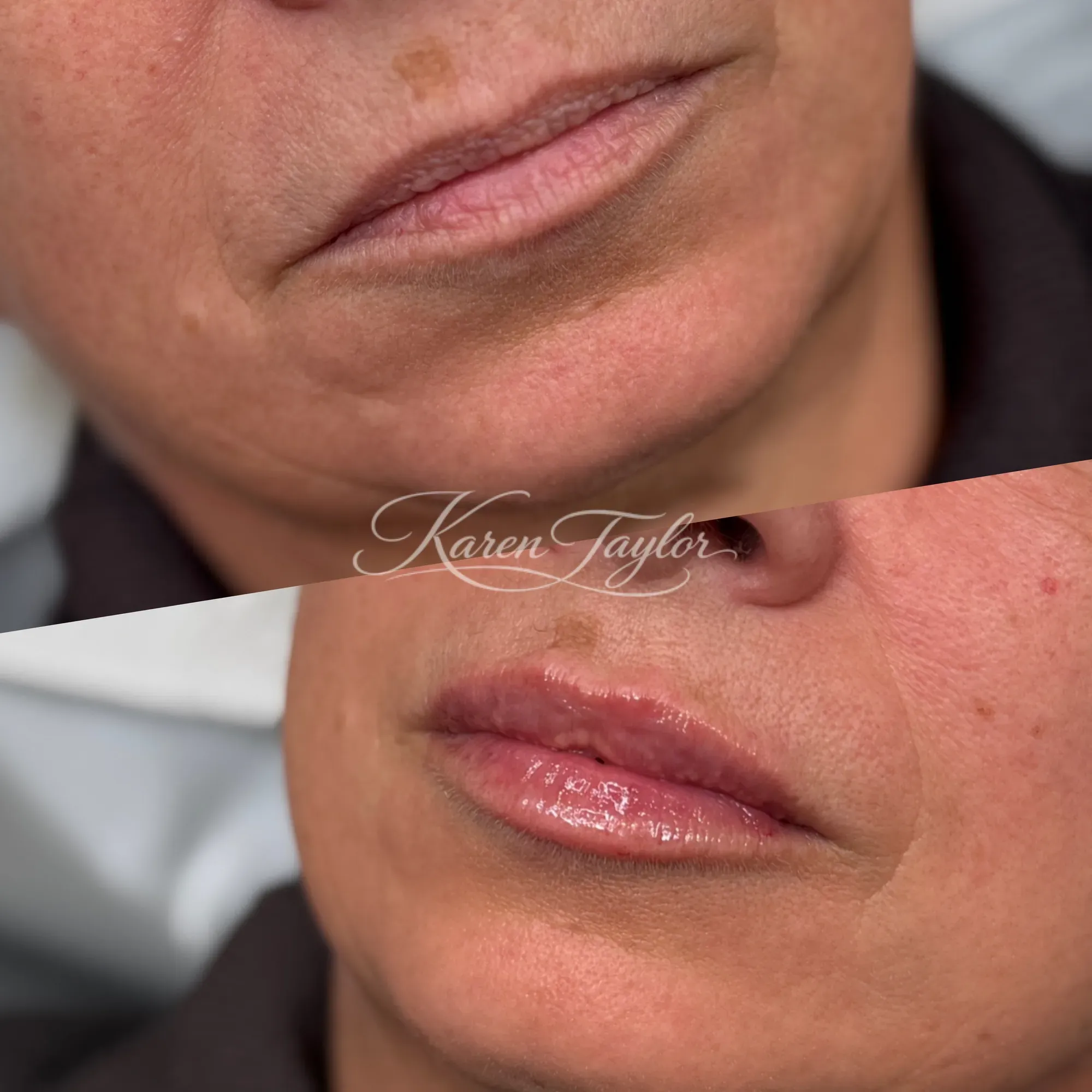 Lip Filler result