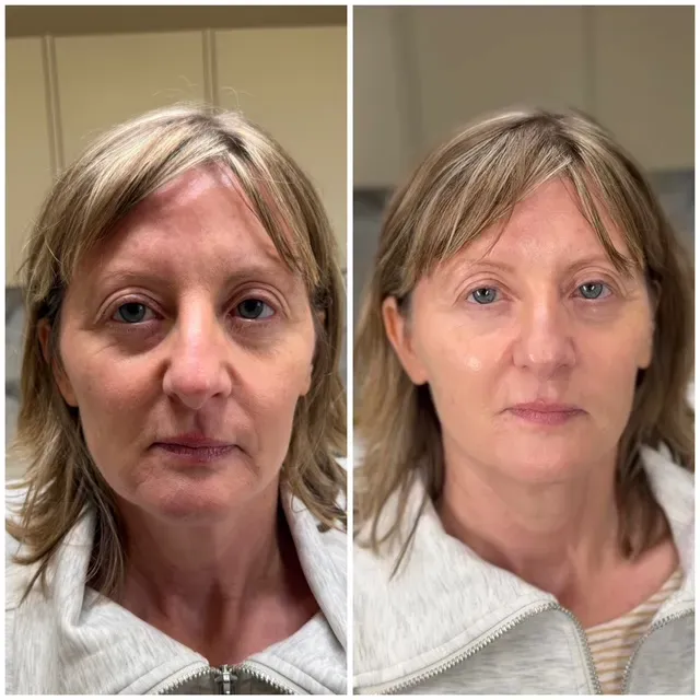 Before & After Dermal Filler result