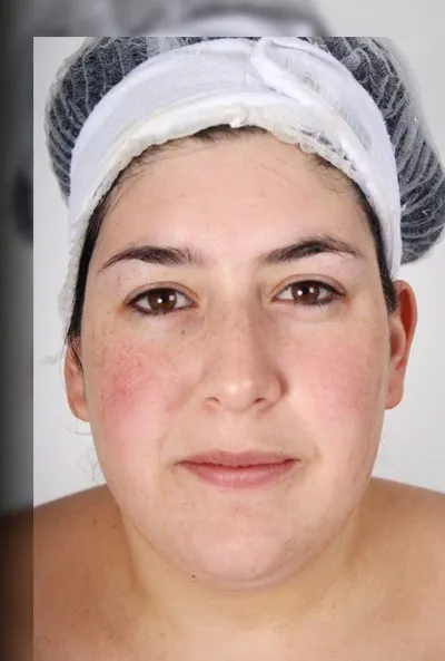 Nimue client 1, after treatment