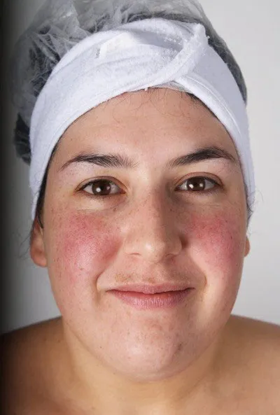 Nimue client 1, before treatment