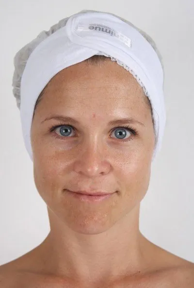 Nimue client 2, before treatment