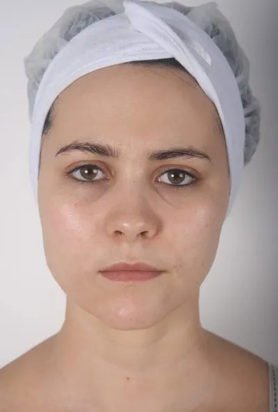 Nimue client 3, after treatment