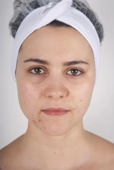Nimue client 3, before treatment